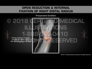 Open Reduction & Internal Fixation of Right Distal Radius - Medical Animation Open Reduction & Internal Fixation of Right Distal Radius - Medical Animation