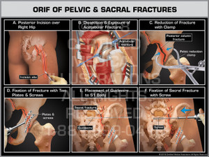 ORIF of Pelvic & Sacral Fractures - Print Quality Instant Download ORIF of Pelvic & Sacral Fractures - Print Quality Instant Download