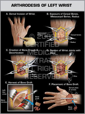 Exhibit of Arthrodesis of Left Wrist.