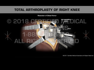 Total Arthroplasty of the Right Knee - Medical Animation Total Arthroplasty of the Right Knee - Medical Animation