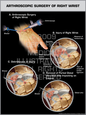 Exhibit of Arthroscopic Surgery of Right Wrist.