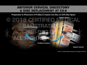 Anterior Cervical Discectomy & Disc Replacement at C5-6 - Medical Animation Anterior Cervical Discectomy & Disc Replacement at C5-6 - Medical Animation