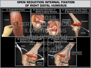 The exhibit illustrates the open reduction internal fixation of the right arm.  The elbow is incised and dissected to expose both medial & lateral windows. The scar tissue hematoma is debrided. The fracture is repaired by realigning the bone and attaching plates and screws.