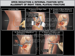 The exhibit illustrates the open reduction and internal fixation of a right knee tibial plateau fracture. An incision is made to expose the right tibial fracture. A bone window is created and the bone is elevated the depressed joint surface. The Allograft is placed into the defect to help stabilize the joint surface and a locking plate and screws are affixed to complete the fixation. The exhibit illustrates the open reduction and internal fixation of a right knee tibial plateau fracture. An incision is made to expose the right tibial fracture. A bone window is created and the bone is elevated the depressed joint surface. The Allograft is placed into the defect to help stabilize the joint surface and a locking plate and screws are affixed to complete the fixation.