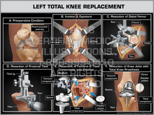 The exhibit illustrates a typical left total knee replacement. The preoperative condition of the knee joint usually includes arthritis. An incision along with an arthrotomy of the joint is made to expose the knee joint. The distal femur & proximal tibia are resected using an intramedullary jig and bone saw. The patella surface is also prepared with a jig and saw. Once all surfaces are prepared and the trial components are sized, the femoral and tibial components, spacer and patellar button are placed. The knee joint is reduced and the total knee prosthesis is tested.