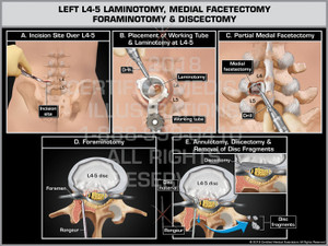 The exhibit illustrates decompression surgery of the left lumbar spine at the L4-5 level. An incision is made over left L4-5 for the placement of a working tube. A laminotomy and partial medial facetectomy is completed. The nerve root is decompressed with a foraminotomy. The partial discectomy is started with incising the annulus to remove the disc fragments. The exhibit illustrates decompression surgery of the left lumbar spine at the L4-5 level. An incision is made over left L4-5 for the placement of a working tube. A laminotomy and partial medial facetectomy is completed. The nerve root is decompressed with a foraminotomy. The partial discectomy is started with incising the annulus to remove the disc fragments.