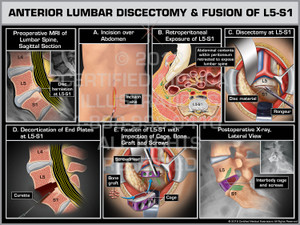 The exhibit illustrates an anterior lumbar discectomy and fusion of the L5-S1 level. The preoperative MRI depicts the disc herniation impinging the thecal sac. The surgery is started with the incision over the abdomen. The abdominal contents within the peritoneum are retracted to expose the lumbar spine. The L5-S1 is incised and followed by a discectomy to remove all disc material. The end plates are decorticated with a curette. Fixation of L5-S1is completed with the impaction of cage, bone graft and screws. Finally the postoperative x-rays show the surgical hardware from the lateral view. The exhibit illustrates an anterior lumbar discectomy and fusion of the L5-S1 level. The preoperative MRI depicts the disc herniation impinging the thecal sac. The surgery is started with the incision over the abdomen. The abdominal contents within the peritoneum are retracted to expose the lumbar spine. The L5-S1 is incised and followed by a discectomy to remove all disc material. The end plates are decorticated with a curette. Fixation of L5-S1is completed with the impaction of cage, bone graft and screws. Finally the postoperative x-rays show the surgical hardware from the lateral view.