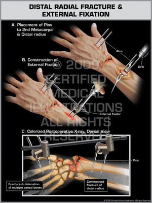 Exhibit of Distal Radial Fracture & External Fixation 1. Exhibit of Distal Radial Fracture & External Fixation 1.