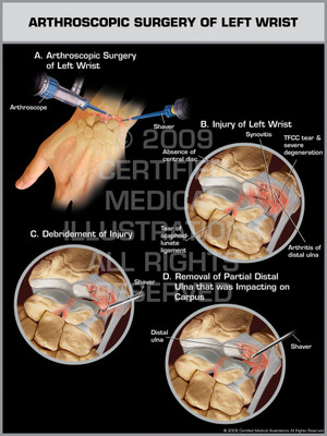 Exhibit of Arthroscopic Surgery of Left Wrist.