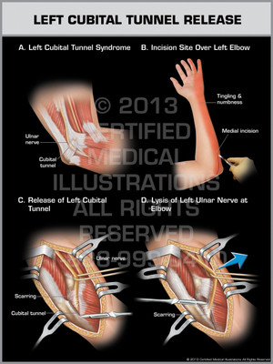 Exhibit of Left Cubital Tunnel Release.