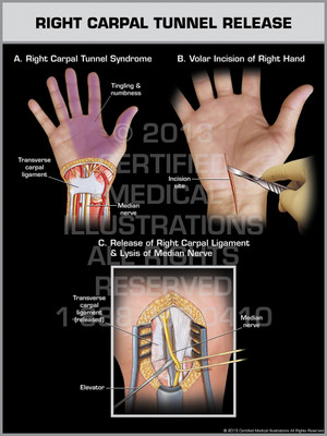 Exhibit of Right Carpal Tunnel Release.