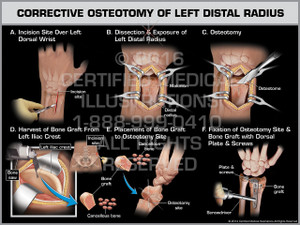 Exhibit of Corrective Osteotomy of Left Distal Radius. Exhibit of Corrective Osteotomy of Left Distal Radius.