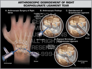 Exhibit of Arthroscopic Debridement of Right Scapholunate Ligament Tear.