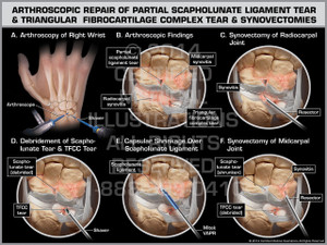 Exhibit of Arthroscopic Repair of Partial Scapholunate Ligament Tear & Triangular Fibrocartilage Complex Tear & Synovectomies. Exhibit of Arthroscopic Repair of Partial Scapholunate Ligament Tear & Triangular Fibrocartilage Complex Tear & Synovectomies.