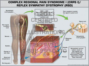 Exhibit of Complex Regional Pain Syndrome I (CRPS I)/ Reflex Sympathy Dystrophy (RSD). Exhibit of Complex Regional Pain Syndrome I (CRPS I)/ Reflex Sympathy Dystrophy (RSD).