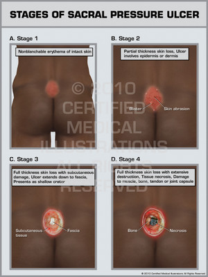 Exhibit of Stages of Sacral Pressure Ulcer. Exhibit of Stages of Sacral Pressure Ulcer.