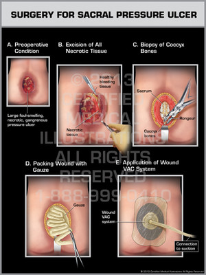 Exhibit of Surgery for Sacral Pressure Ulcer.