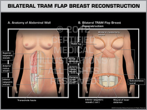 Exhibit of Bilateral Tram Flap Breast Reconstruction. Exhibit of Bilateral Tram Flap Breast Reconstruction.