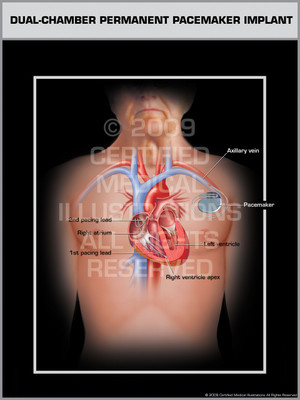 Exhibit of Dual-Chamber Permanent Pacemaker Implant Male. Exhibit of Dual-Chamber Permanent Pacemaker Implant Male.
