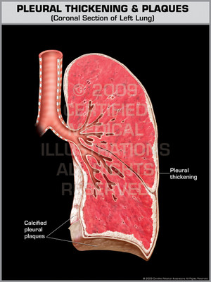 Exhibit of Pleural Thickening & Plaques.