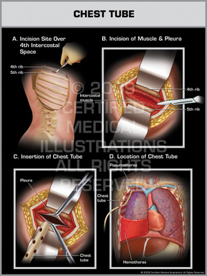 Exhibit of Chest Tube Female.