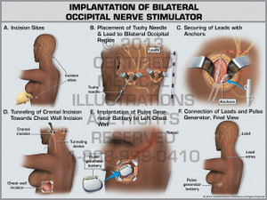 Exhibit of Implantation of Bilateral Occipital Nerve Stimulator. Exhibit of Implantation of Bilateral Occipital Nerve Stimulator.
