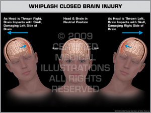 Exhibit of Whiplash Closed Brain Injury Female.