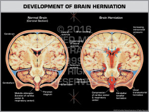 Exhibit of Development of Brain Herniation Coronal Section.