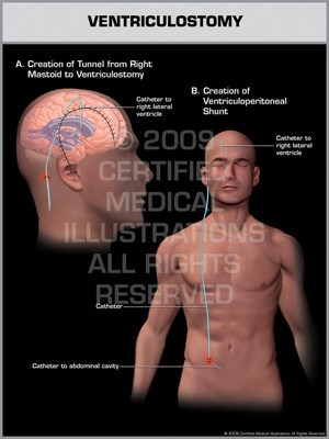 Exhibit of Ventriculostomy Male.