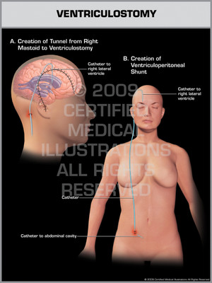 Exhibit of Ventriculostomy Female. Exhibit of Ventriculostomy Female.