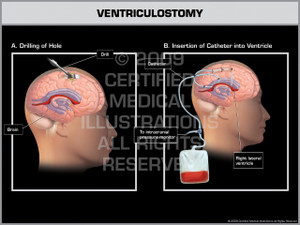 Exhibit of Ventriculostomy Female I. Exhibit of Ventriculostomy Female I.