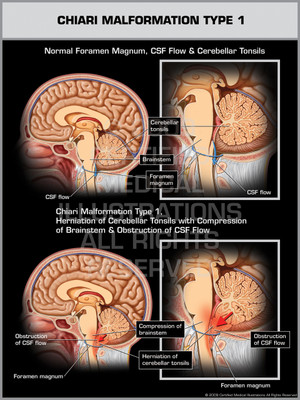 Exhibit of Chiari Malformation Type I. Exhibit of Chiari Malformation Type I.