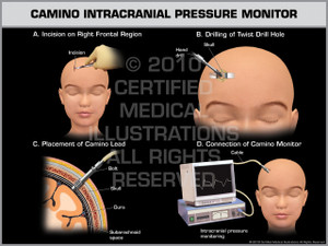 Exhibit of Camino Intracranial Pressure Monitor Child.