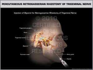 Exhibit of Percutaneous Retrogasserian Rhizotomy of Trigeminal Nerve Male. Exhibit of Percutaneous Retrogasserian Rhizotomy of Trigeminal Nerve Male.