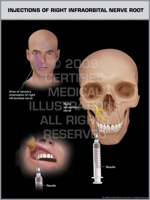 Exhibit of Injections of Right Infraorbital Nerve Root. Exhibit of Injections of Right Infraorbital Nerve Root.