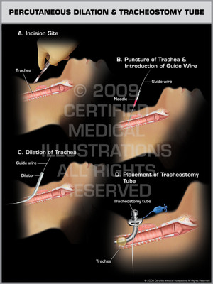 Exhibit of Percutaneous Dilation & Tracheostomy Tube.
