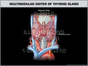 Exhibit of Multinodular Goiter of Thyroid Gland. Exhibit of Multinodular Goiter of Thyroid Gland.