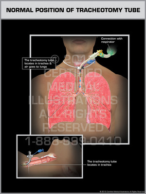 Exhibit of Normal Position of Tracheotomy Tube. Exhibit of Normal Position of Tracheotomy Tube.