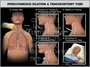 Exhibit of Percutaneous Dilation & Tracheostomy Tube Female. Exhibit of Percutaneous Dilation & Tracheostomy Tube Female.