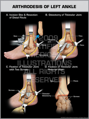 Exhibit of Arthrodesis of Left Ankle. Exhibit of Arthrodesis of Left Ankle.