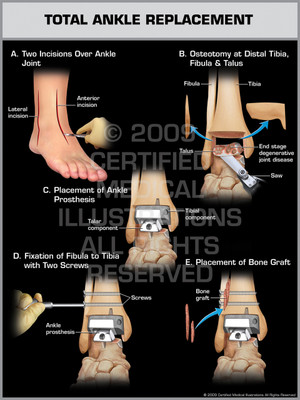 Exhibit of Total Ankle Replacement. Exhibit of Total Ankle Replacement.