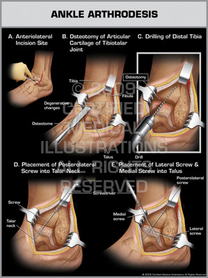 Exhibit of Ankle Arthrodesis.