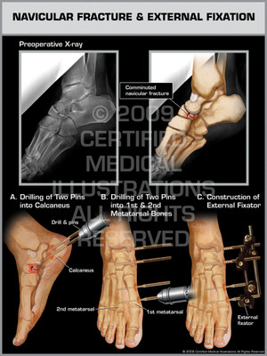 Exhibit of Navicular Fracture & External Fixation.