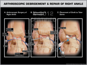 Exhibit of Arthroscopic Debridement & Repair of Right Ankle.