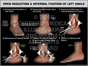 Exhibit of Open Reduction & Internal Fixation of Left Ankle.