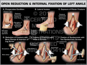 Exhibit of Open Reduction & Internal Fixation of Left Ankle. Exhibit of Open Reduction & Internal Fixation of Left Ankle.