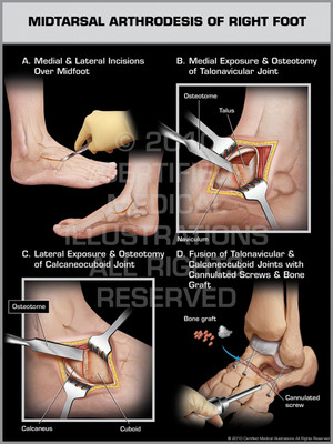 Exhibit of Midtarsal Arthrodesis of Right Foot. Exhibit of Midtarsal Arthrodesis of Right Foot.