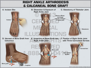 Exhibit of Right Ankle Athrodesis & Calcaneal Bone Graft. Exhibit of Right Ankle Athrodesis & Calcaneal Bone Graft.