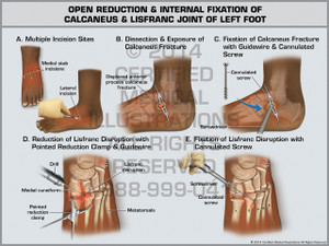 Exhibit of Open Reduction & Internal Fixation of Calcaneus & Lisfranc Joint of Left Foot. Exhibit of Open Reduction & Internal Fixation of Calcaneus & Lisfranc Joint of Left Foot.