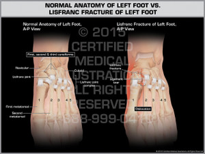 Exhibit of Normal Anatomy of Left Foot vs. Lisfranc Fracture of Left Foot. Exhibit of Normal Anatomy of Left Foot vs. Lisfranc Fracture of Left Foot.